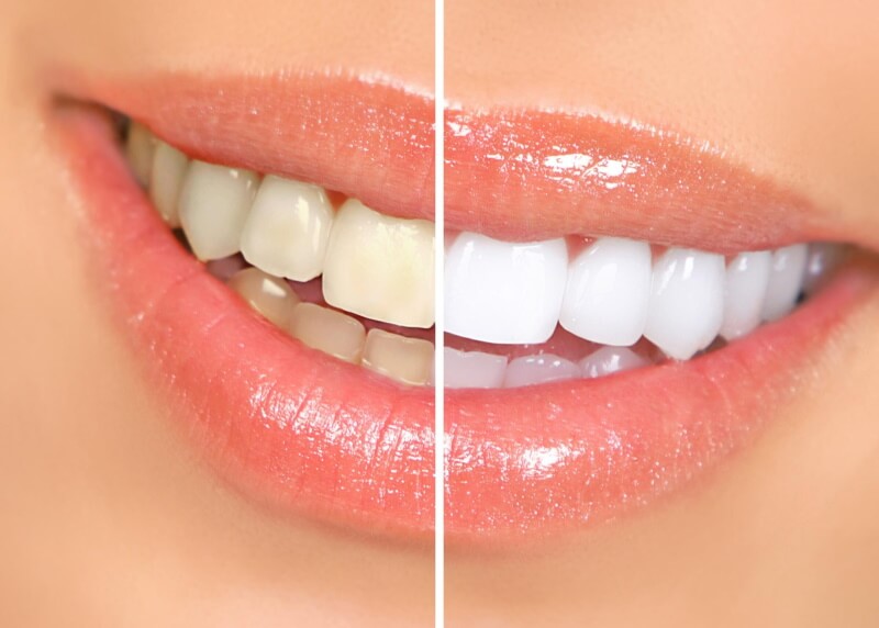 Clareamento Dental em Braganca Paulista